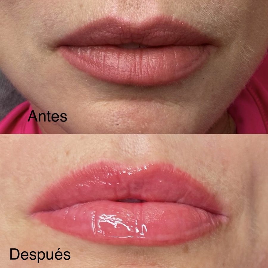 Lip Treatment